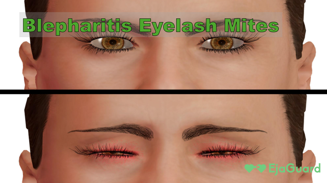 Blepharitis Eyelash Mites: Symptoms, Causes, and Best Treatments