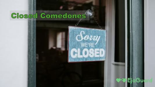 Closed Comedones: Causes, Treatment, and How to Get Rid of Them Fast